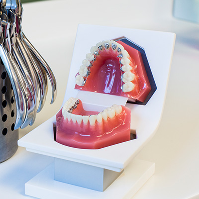 L’orthodontie linguale invisible